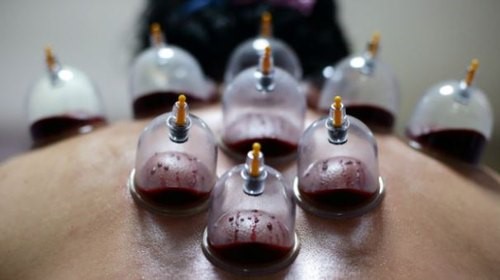 BEKAM disebut juga dengan Hijamah atau Cupping Therapy
      yang secara tradisional adalah sebuah usaha menarik darah kotor atau racun ke permukaan tubuh atau ruang bawah kulit. Secara medis modern adalah proses
      pemvakuman sehingga menimbulkan tekanan negatif pada kop, efeknya terjadi mekanisme peradangan ringan dan hipoksia jaringan. Kondisi hipoksia ini akan
      memberikan efek yang baik untuk merangsang sistem tubuh memproduksi sel darah merah, merangsang pengeluaran hormon endorfin sehingga menimbulkan efek
      vasodilatasi dan relaksasi otot dan menenangkan saraf simpatis. Selanjutnya ketika kulit dilukai atau ditusuk, maka akan membuka skin barrier dan akan
      menarik atau mengeluarkan darah kotor atau racun tadi. Kondisi inilah yang akan menimbulkan sensasi ringan dan nyaman setelah dibekam.
      Mekanisme kerja bekam tersebut telah membuka tabir kebenaran terkait konsep pengobatan bekam yang sudah diperintahkan oleh Rasulullah SAW dengan sabdanya
      yang berbunyi : 'Sesunggunya sebaik-baik pengobatan yang kalian pergunakan sebagai obat adalah Hijamah (Bekam)' (HR. Bukhari & Muslim).
      Bekam memiliki beragam manfaat, antara lain dapat melancarkan peredaran darah, mengatasi kelelahan, meredakan nyeri, membuang racun tubuh, memperbaiki
      sistem imun tubuh, mengatasi sakit kepala, menurunkan berat badan, serta beragam manfaat lainnya.